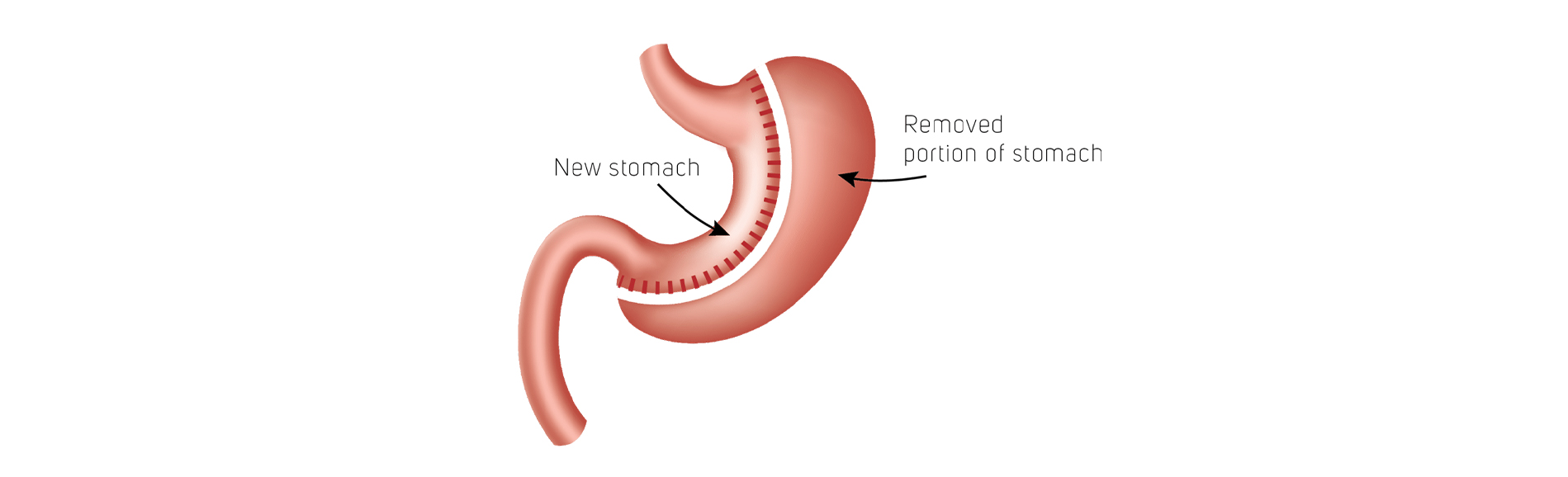 Duodenal Switch